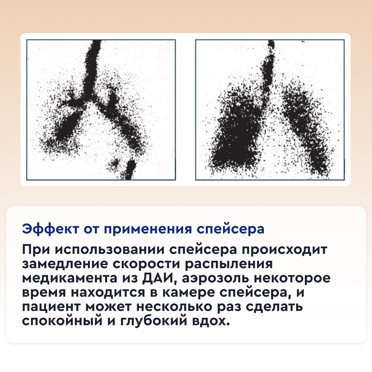 Антистатическая клапанная камера/спейсер VORTEX тип 051 с маской "Божья коровка"для млад. от 0 до 2  от интернет-магазина trimm.store